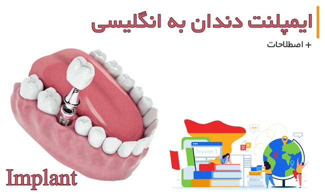 ایمپلنت دندان به انگلیسی (اصلاحات پرکاربرد )